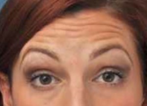 Forehead Lines Before